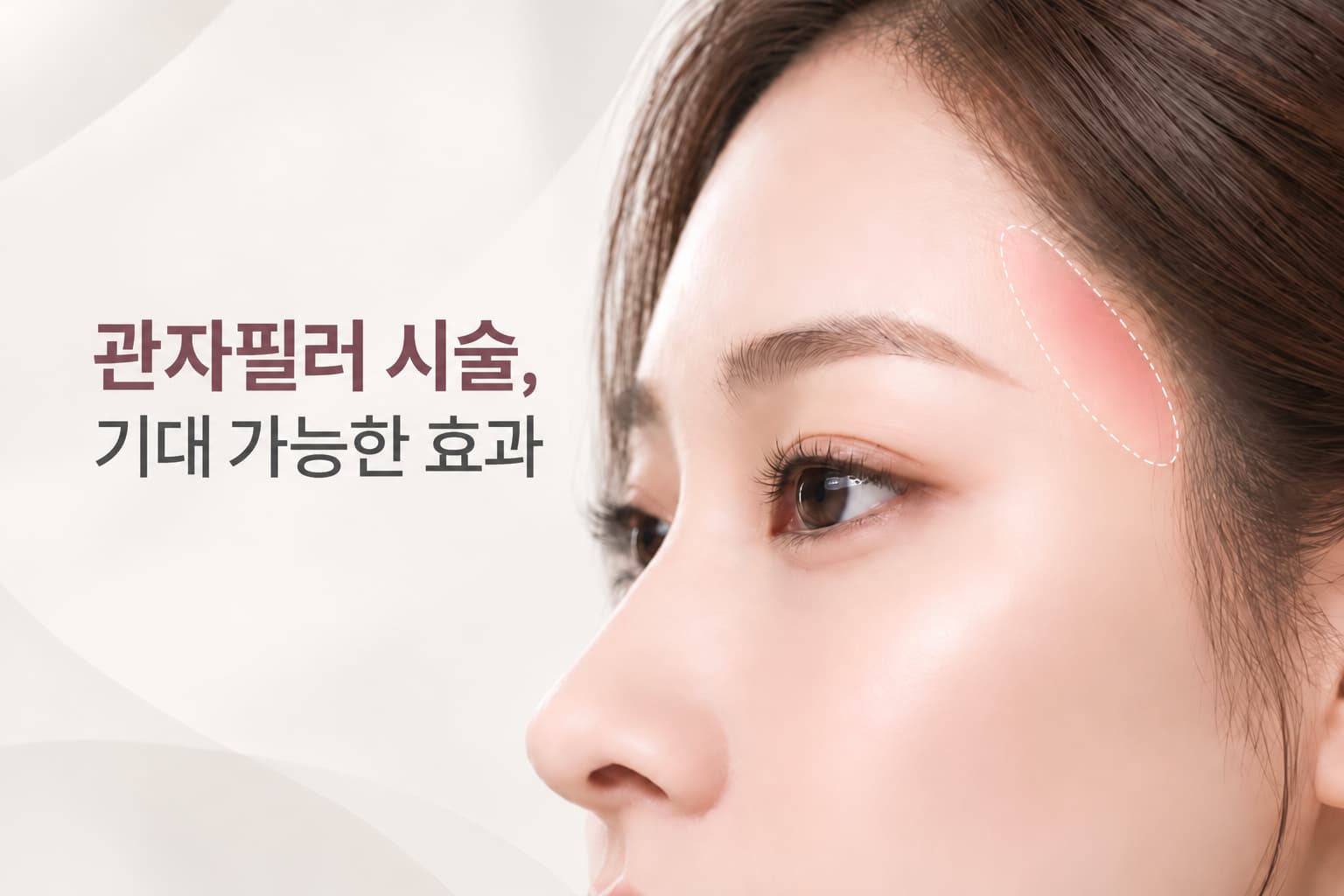 관자필러, 어떤 효과를 기대할 수 있을까 시술 전 확인할 기준  선릉 유앤아이