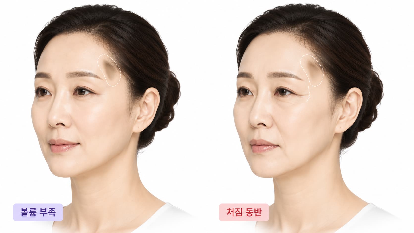 관자필러, 어떤 효과를 기대할 수 있을까 시술 전 확인할 기준 선릉 유앤아이