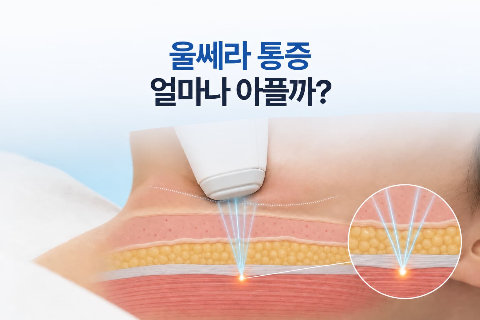 울쎄라 통증 얼마나 아플까? 부위별 차이와 시술 후 지속기간